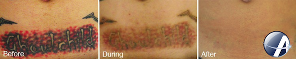 Tattoo Removal Laser Results Photos