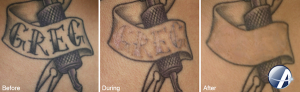 Tattoo Removal Before & After photos