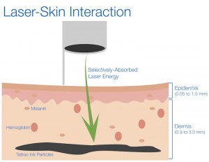 Laser-Skin Interaction