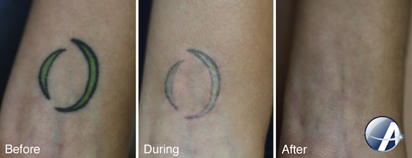 Laser Tattoo Removal Results Photos | New Look Laser College
