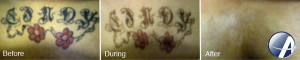 Tattoo Removal Before & After photos