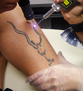 Laser Tattoo Removal with Astanza Revolution