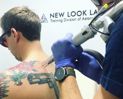 laser tattoo removal overview