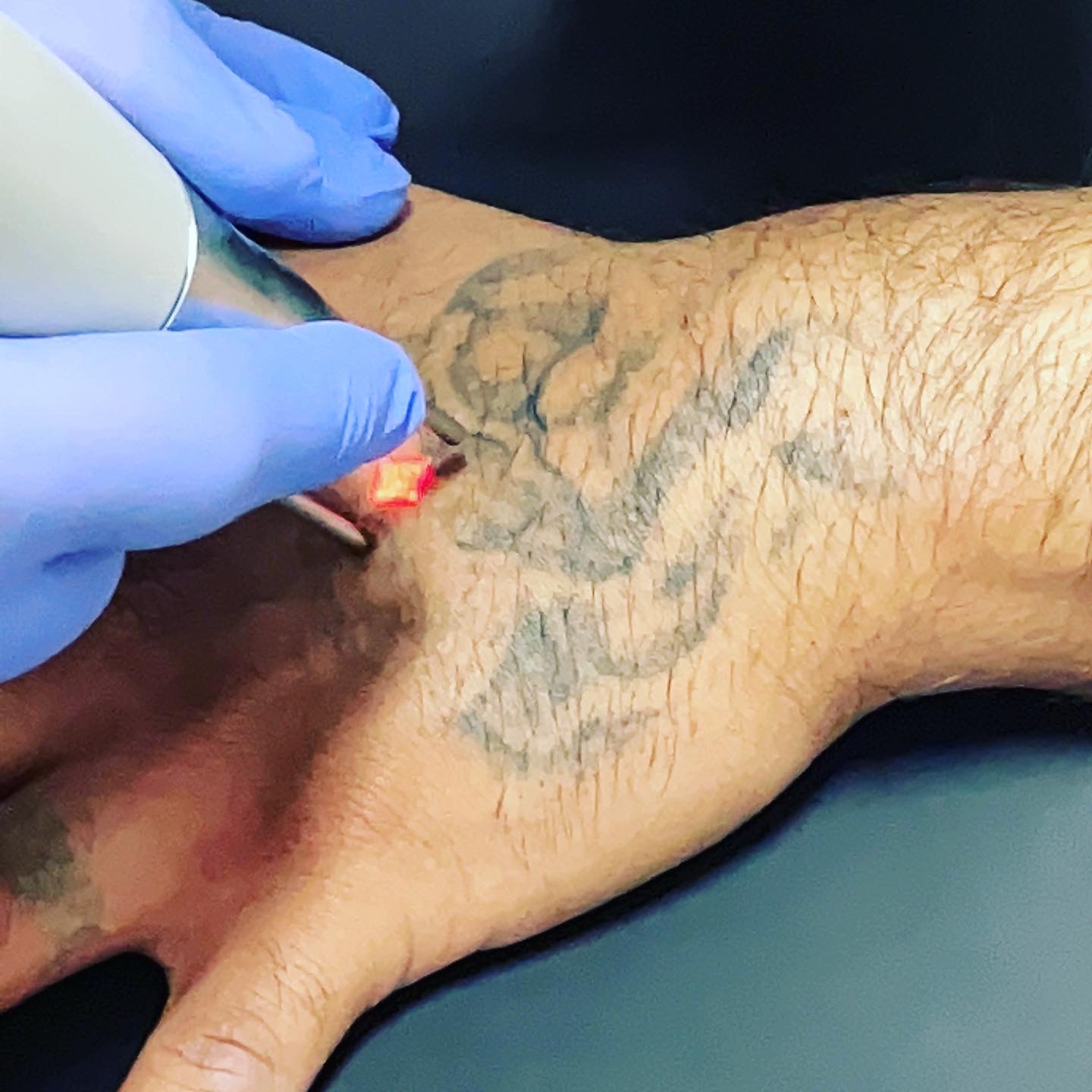 How to Remove Tattoos - New Look Laser College
